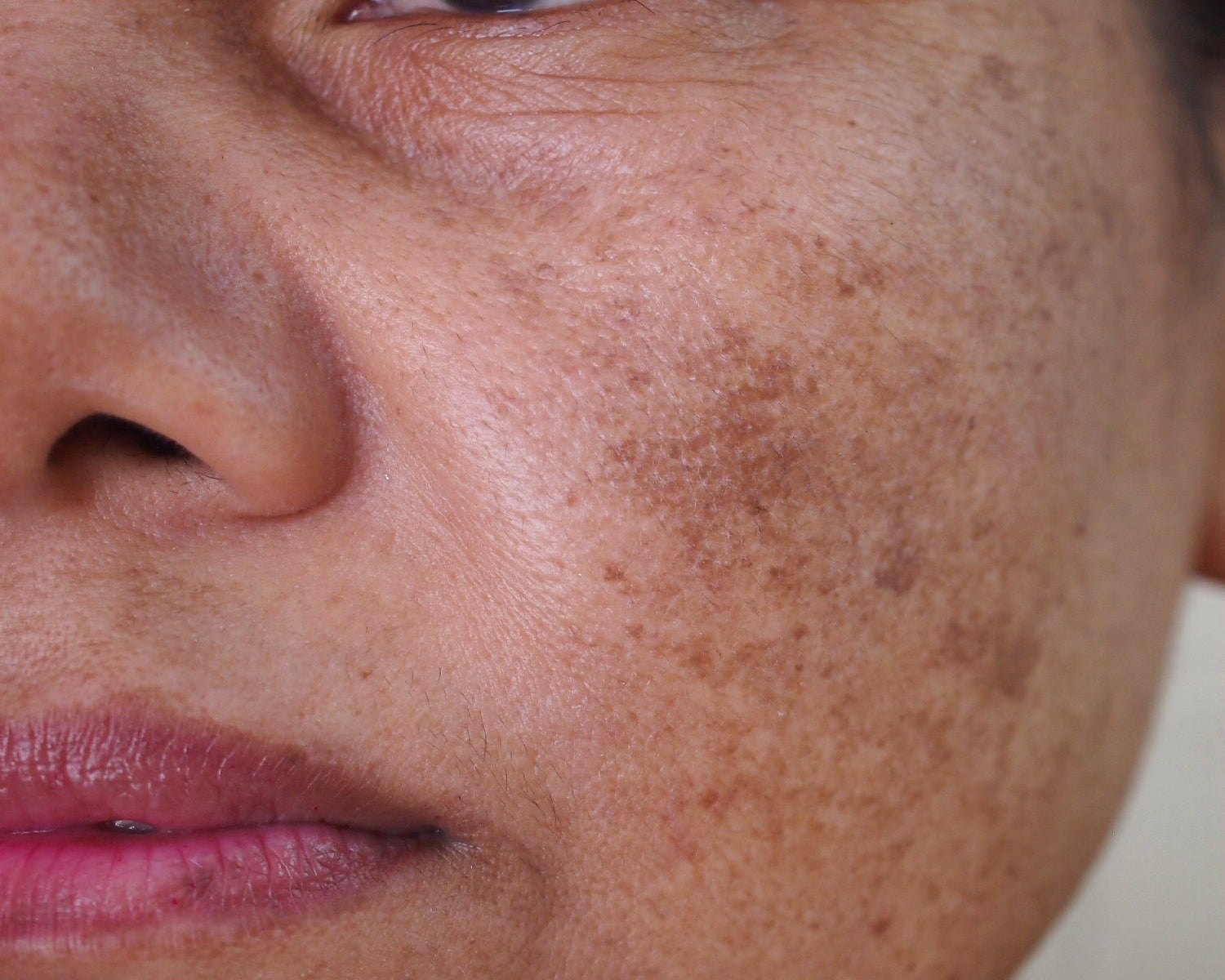 Melasma: A Deep Dive Into Causes, Treatments and Real Results