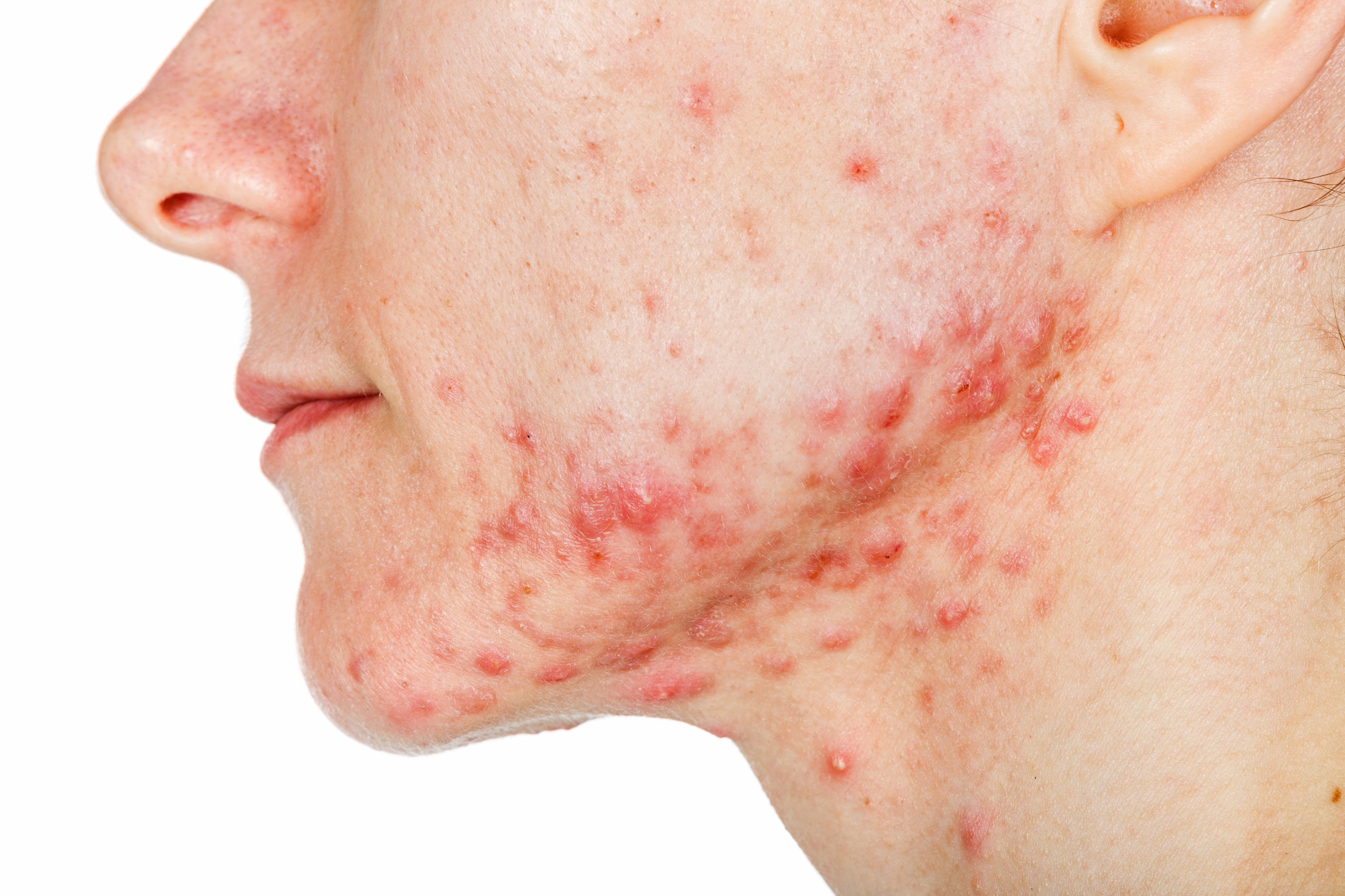 Clear Choice - Hormonal Acne